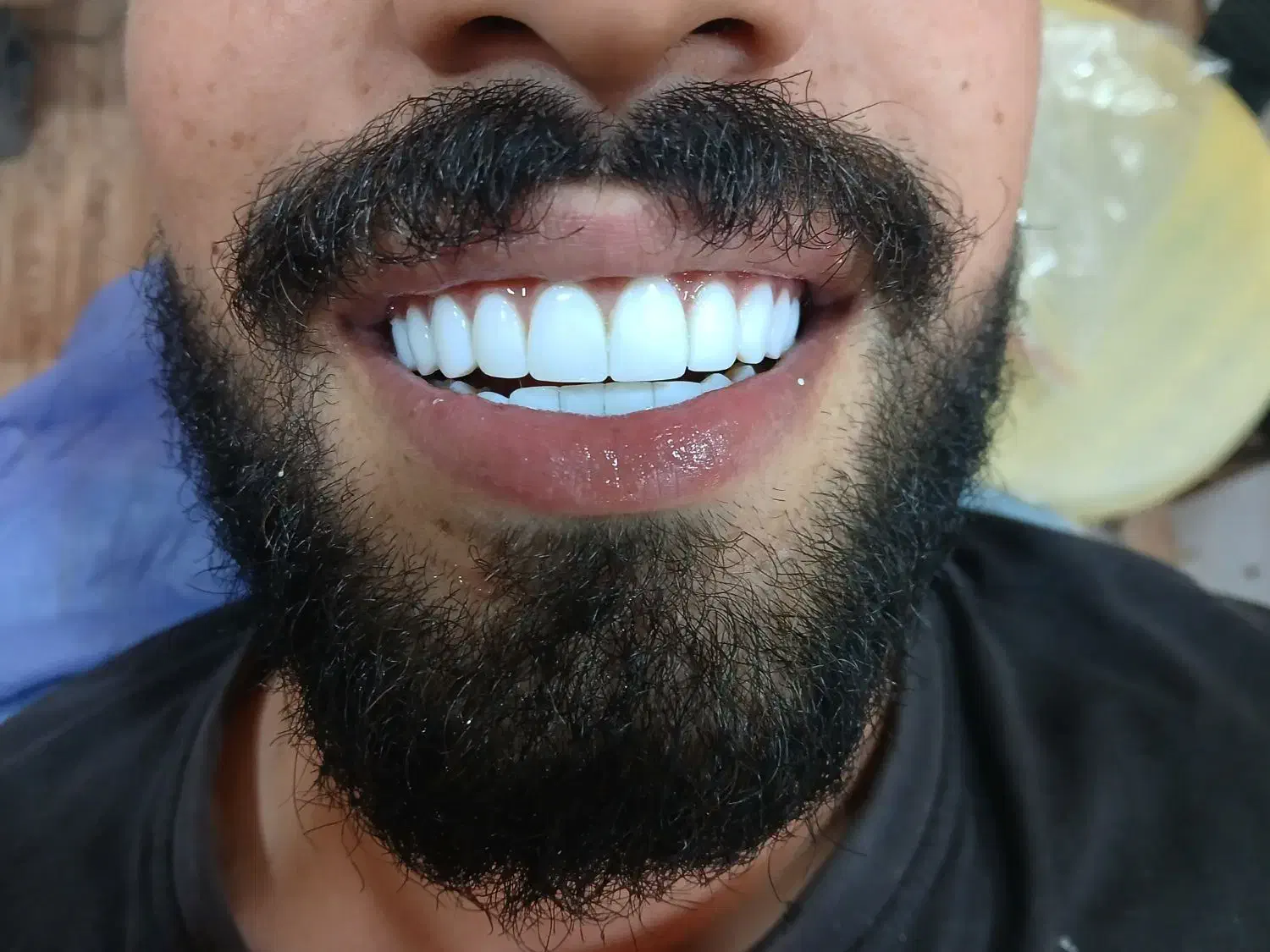 انجام کامپوزیت ونیر با بهترین متریال با افر ۶۰٪|خدمات آرایشگری و زیبایی|بابل, |دیوار