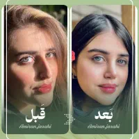 اصلاح فرم بینی،باحفظ تناسب چهره