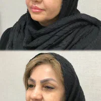 تزریق ژل ،بوتاکس ،لیزر موهای زائد، ساکشن غبعب|خدمات آرایشگری و زیبایی|تهران, صد دستگاه|دیوار