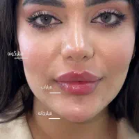 تزریق ژل وجوانسازی تخصصی ومزو ژل،بوتاکس