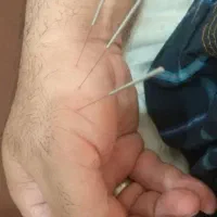 جشنواره حجامت با بادکش سرد ۱۵۰ فقط امروز