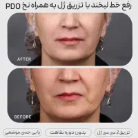 تزریق ژلوبوتاکس تخصصی در پرندبا نازلترین قیمت|خدمات آرایشگری و زیبایی|پرند, فاز ۲|دیوار