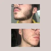 خداحافظی با کم پشتی ر ی ش و س ی ب ی ل