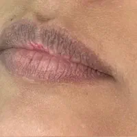 رفع کبودی لب