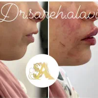 جشنواره تخفیف تزریق فیلر لب به مدت محدود توسط پزشک|خدمات آرایشگری و زیبایی|قم, دورشهر|دیوار