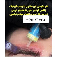 ریموو تتو با اشانتیون  در کلینیک زیبایی|خدمات آرایشگری و زیبایی|تهران, تهرانپارس غربی|دیوار