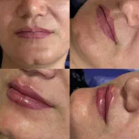 جشنواره ژل توسط پزشک برای شما عزیزان|خدمات زیبایی و سلامت|کرمانشاه, |دیوار