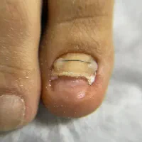 خدمات ارتونیل(ارتودنسی ناخن)وکفسابی ،درمان میخچه|خدمات آرایشگری و زیبایی|تهران, دردشت|دیوار