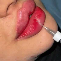 آف فیلر و بوتاکس