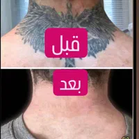 مرکز ریمو،پاک کردن،ریموو تتوابرو.بدن.خط چشم بالیزر|خدمات آرایشگری و زیبایی|شیراز, فرهنگ شهر|دیوار