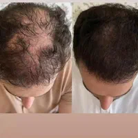 میکرواسکالپ / اسکالپ جایگزین کاشت مو تضمینی|خدمات آرایشگری و زیبایی|مشهد, شهید فرامرز عباسی|دیوار
