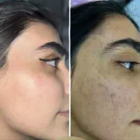 پک صابون و سرم شیر الاغ برطرف کننده لک و جوش صورت|آرایشی، بهداشتی، درمانی|زابل, |دیوار