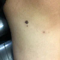 حذف انواع خال (گوشتی،سطحی،زیگیل)|خدمات آرایشگری و زیبایی|کاشان, فاز ۲ ناجی آباد|دیوار