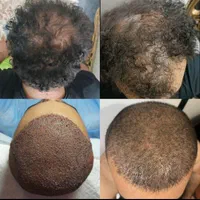 کاشت مو طبیعی شیراز|خدمات آرایشگری و زیبایی|شیراز, قصرالدشت|دیوار