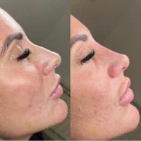 فیلر بینی  برطرف کردن قوز بینی  بینی شکسته و کج|خدمات آرایشگری و زیبایی|خرم‌آباد, |دیوار
