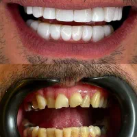دندان پزشکی/کامپوزیت/روکش