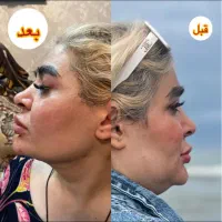 مرکز تخصصی ساکشن غبغب بوکال فت بلفارو کاشت ابرو|خدمات آرایشگری و زیبایی|تهران, پونک|دیوار