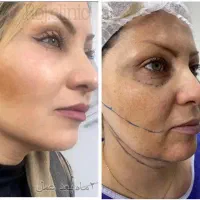 تخفیف مشاوره جراحی زیبایی صورت و لیپو شکم