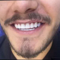 ساخت دندان مصنوعی متحرک و ثابت