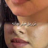 ژل ،بوتاکس لیزر مو رفع تتو پاکسازی هایفو توسط پزشک|خدمات آرایشگری و زیبایی|پرند, فاز ۲|دیوار