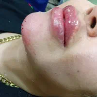 مدل ژل وبوتاکس|خدمات آرایشگری و زیبایی|اهواز, فاز ۲ پادادشهر|دیوار