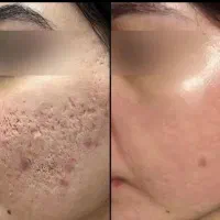 کرم معجزه اصله ضد لک جوش روشن کننده بدون برگشت