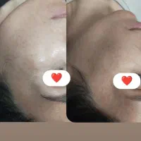 انجام مرونیدلینگ و مشاوره تخصصی پوست ومو