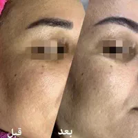فشیال وپاکسازی صورت|خدمات آرایشگری و زیبایی|نیشابور, شهرک اندیشه|دیوار