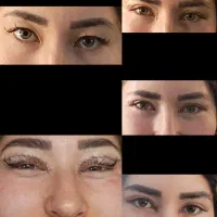 بلفاروپلاستی فقط ۷میلیون