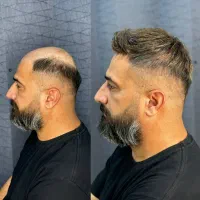 پروتز مو ترمیم مو