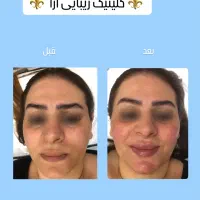 ژل/بوتاکس/مزو ژل/وآموزش|خدمات آرایشگری و زیبایی|خرمشهر, |دیوار