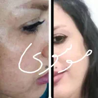 روشن کننده وضدلک درمانی صدرصد تضمینی بدون بازگشت|حراج|یاسوج, |دیوار