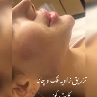 ژل لب روسی بوتاکس هیرفیلر کانتورینگ لیفت صورت|خدمات آرایشگری و زیبایی|تهران, دریا|دیوار