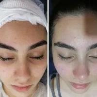 تخفیف ویژه فیشیال تخصصی