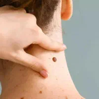 دستگاه خال برداری وزگیل برداری حتی جا های حساس|آرایشی، بهداشتی، درمانی|آبادان, |دیوار