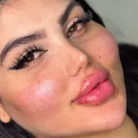 فراخوان مدل ژل و بوتاکس فقط۷۰۰ زیر نظر پزشک