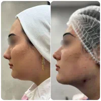 ساکشن تخلیه غبغب لاغری توسط پزشک|خدمات آرایشگری و زیبایی|قم, جهان بینی|دیوار
