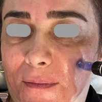 مزونیدلینگ صورت(جوان‌سازی،برطرف کردن جای جوش و لک)|خدمات آرایشگری و زیبایی|بابل, |دیوار