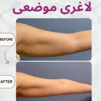 لاغری تضمینی تا ۵۰ درصد تخفیف و یک جلسه هدیه|خدمات آرایشگری و زیبایی|تهران, شهرک صادقیه|دیوار
