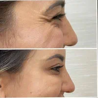 ژل بوتاکس مزو تراپی