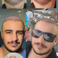 کاشت مو حرفه ای یاسوج VIp