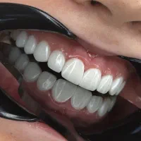 دندانپزشکی با آف ۴۰ درصد رو خدمات زیبایی کامپوزیت
