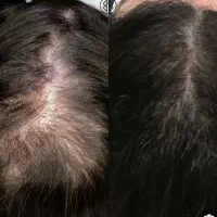 هشدار، ریزش مو داری،این آگهی رو جدی بگیر
