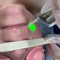 لیزر رفع موهای زائد با دستگاه دکا الکساندرایت|خدمات آرایشگری و زیبایی|کرمانشاه, |دیوار