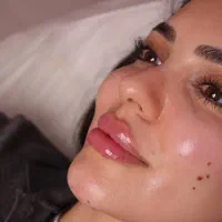 مدل برای درمان افتادگی های صورت و ژل لب و بوتاکس|خدمات آرایشگری و زیبایی|تهران, میرداماد|دیوار