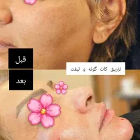 چهره‌ای که عاشقش میشی،بوتاکس،ژل وفیلر توسط متخصص|خدمات آرایشگری و زیبایی|ارومیه, |دیوار