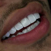 دندانپزشکی اقساطی ایمپلنت کامپوزیت