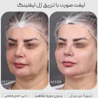 تزریق ژلوبوتاکس تخصصی در پرندبا نازلترین قیمت|خدمات آرایشگری و زیبایی|پرند, فاز ۲|دیوار