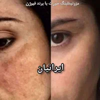 خال،فیلر،بوتاکس،انزیم،تخفیف ۵۰درصدی جشنواره ای|خدمات آرایشگری و زیبایی|کرمانشاه, |دیوار