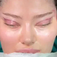 جراحیزیبایی ابدولیپو،بلفاروپلک،پروتز و غیره